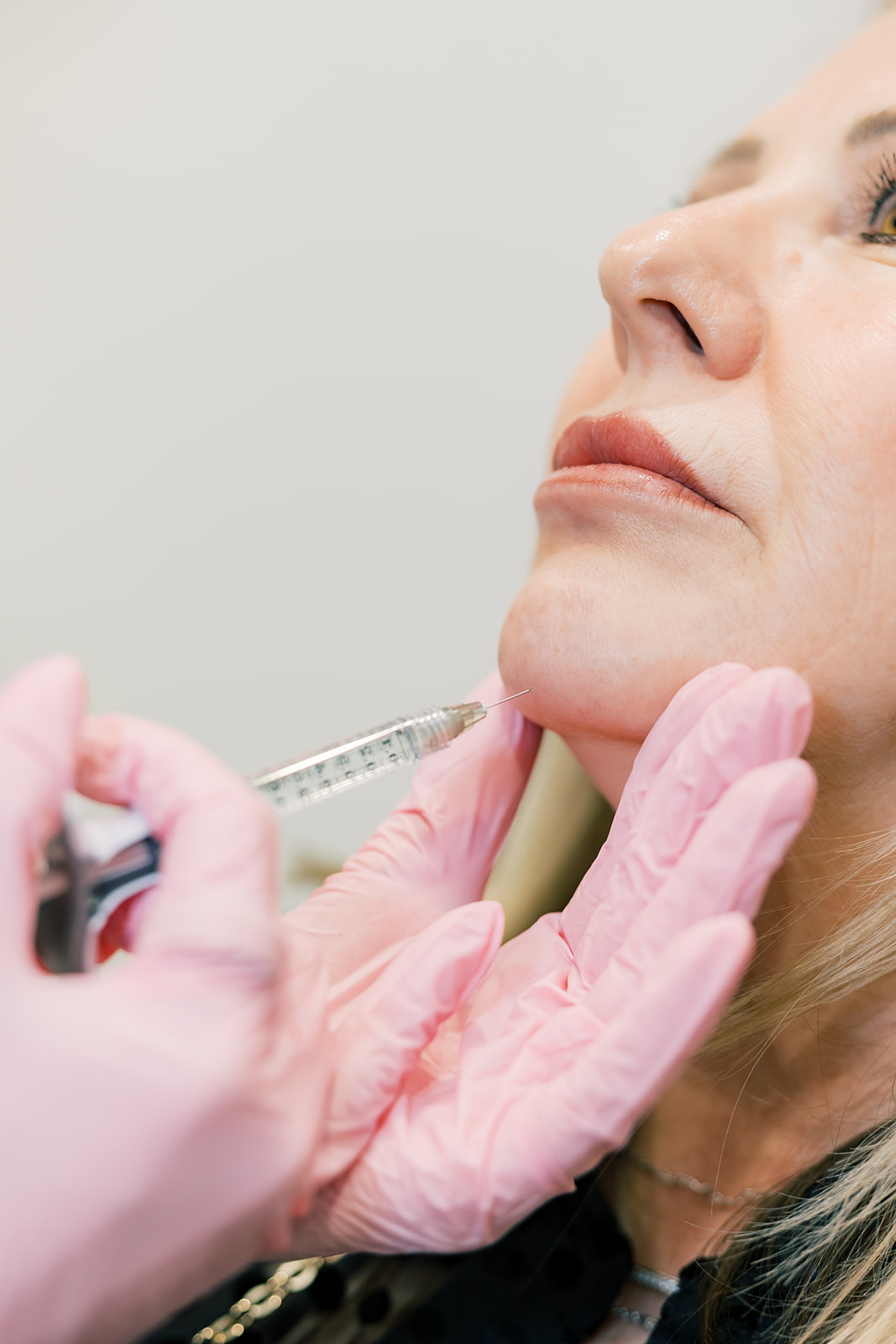 Juvederm + Revanesse